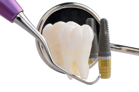 dental implant with dental tools